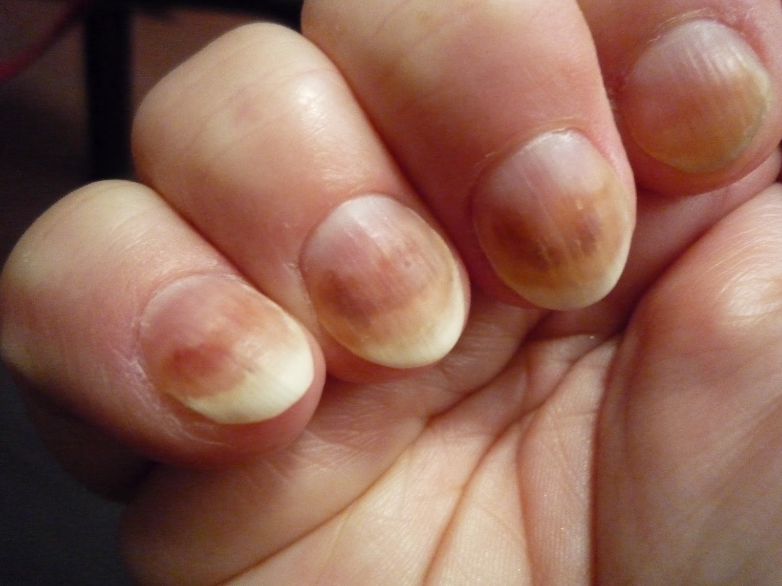 What Are Brown Spots On Fingernails