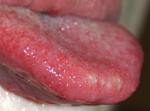 Red-spots-tongue