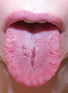 tongue-cracks