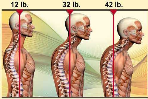 Is Your Head Posture Causing You Pain?