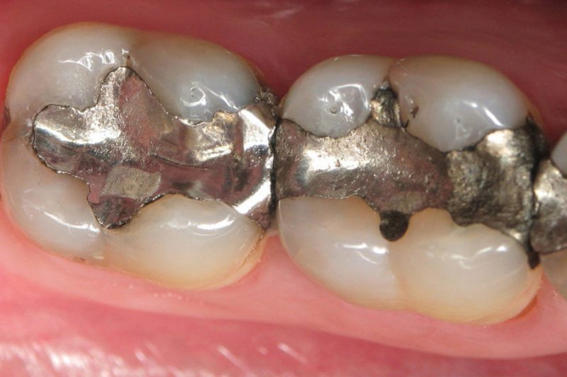 How Mercury Dental Fillings Destroy Your Health