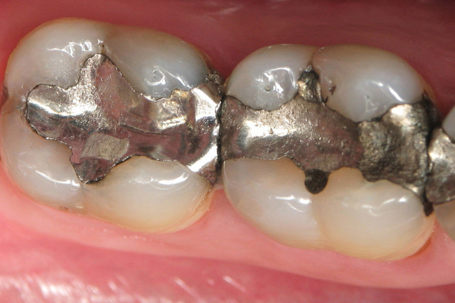 How Mercury Dental Fillings Destroy Your Health Diet Sage